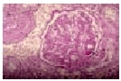 Figure 6.1.2. Histological findings in Group 2. Note the minor PAS-positive deposit in the glomerular basement membrane on the right (arrow) (PAS, 400x). 