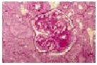 Figure 6.1.3. Histopathological findings in Group 3. Note the obvious PAS-positive deposits in the hilus (arrow) (PAS, 400x). 
