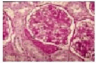 Figure 6.1.4. Histopathological findings in Group 4. Note the intense PAS-positive deposits in Bowmann’s basale membrane (humps) (arrows). Deposits are also seen in the mesangium (PAS, 400x). 