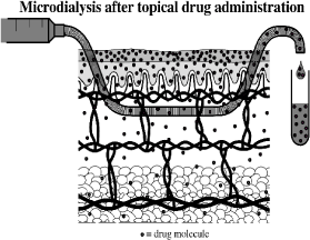 Figure 10: Microdialysis. Probe inserted in the dermis. (Benfeldt & Serup, 1999)